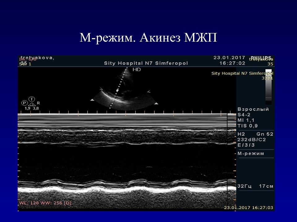 М режим. М режим УЗИ. ЭХОКГ М режим. Клиническая эхокардиография презентация. Акинез по Эхо кг.
