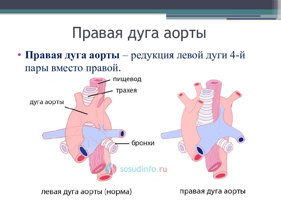 Правая аорта. Праволежащая дуга аорты аномалия развития. Циркуляторная система дуги аорты. Правосторонняя дуга аорты. Правая дуга аорты у плода.