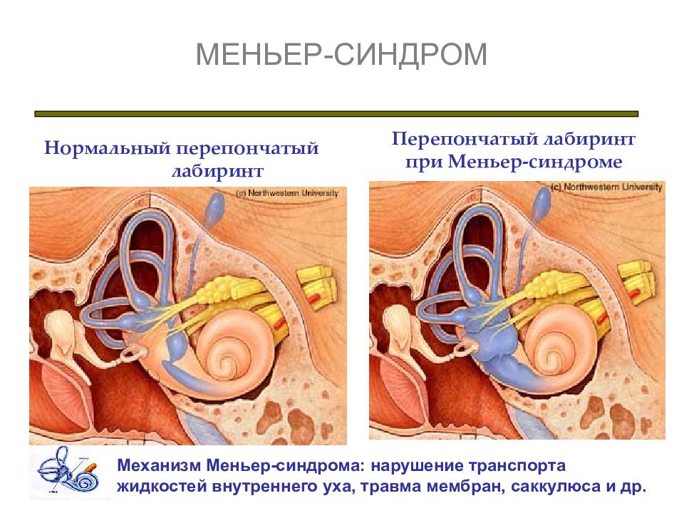 Схема лечения болезни меньера