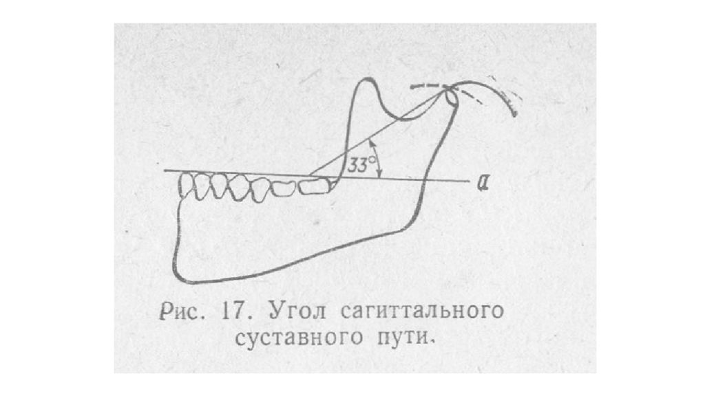 Угол пути. Сагиттальный суставной и резцовый пути. Сагиттальные движения нижней челюсти. Саггмтальные движения нижней челюсти. Угол сагиттального резцового и суставного.