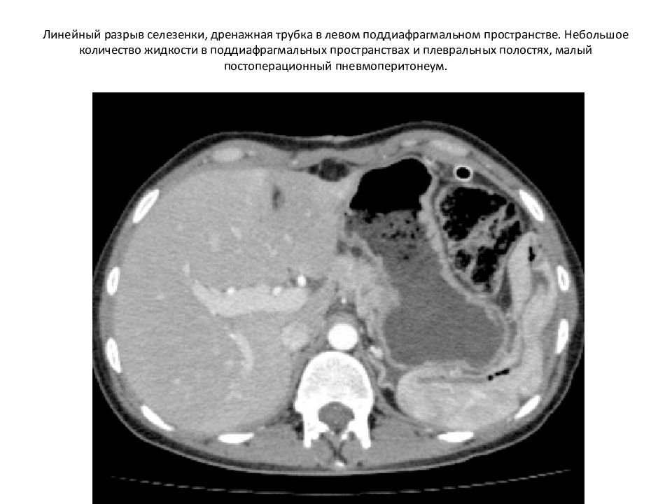 Жидкость в селезенке. Подкапсульная гематома селезенки на кт. Подкапсульные гематомы печени кт. Подкапсульный разрыв печени кт.