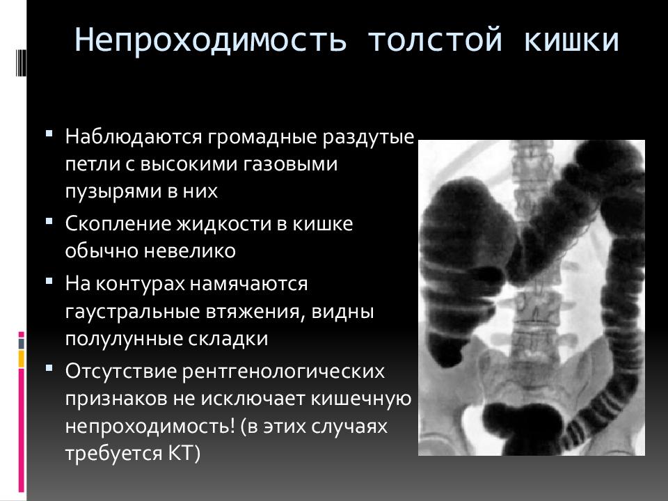 Симптомы пневматоза кишечника лечение. Пневматоз толстой кишки рентген. Петли Толстого кишечника рентген. Раздутые петли Толстого кишечника рентген. Петли кишечника на рентгене.