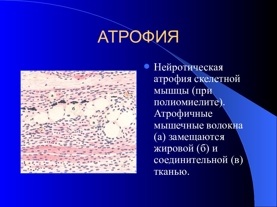 Атрофия презентация патология