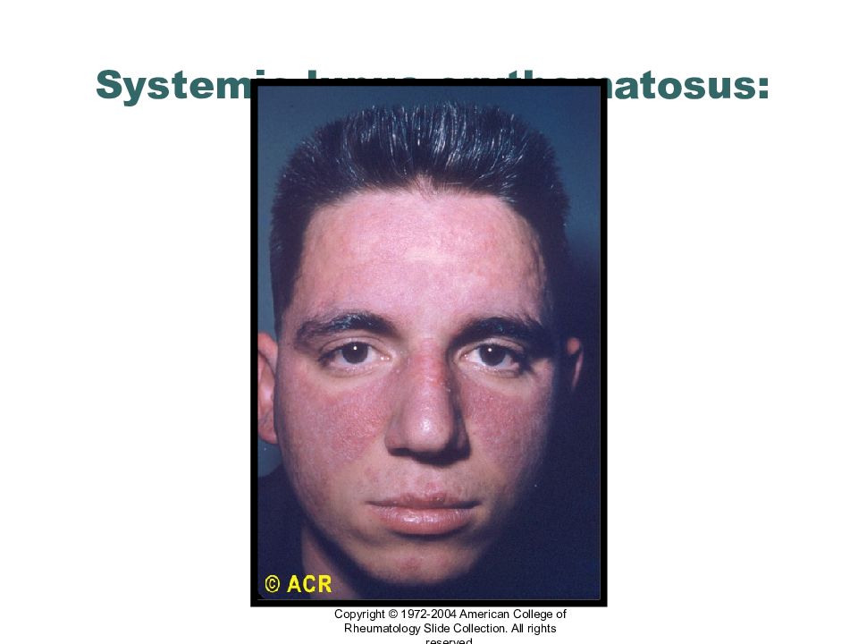 2004 1972. Системная красная волчанка фото. Systemic Lupus erythematosus photo hair loss. Systemic Lupus erythematosus really photo people.