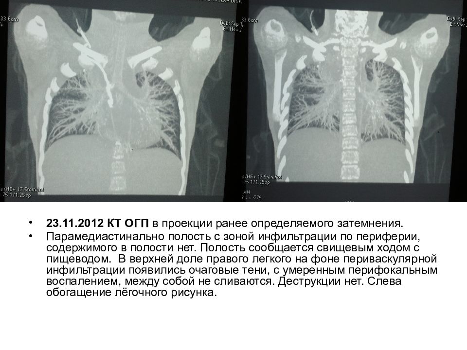 Кт огп. Парамедиастинальный плеврит на кт. Парамедиастинальный осумкованный плеврит рентген. Парамедиастинальный плеврит слева. Парамедиастинальные отделы легких.