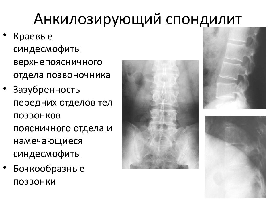 Болезнь бехтерева кт картина