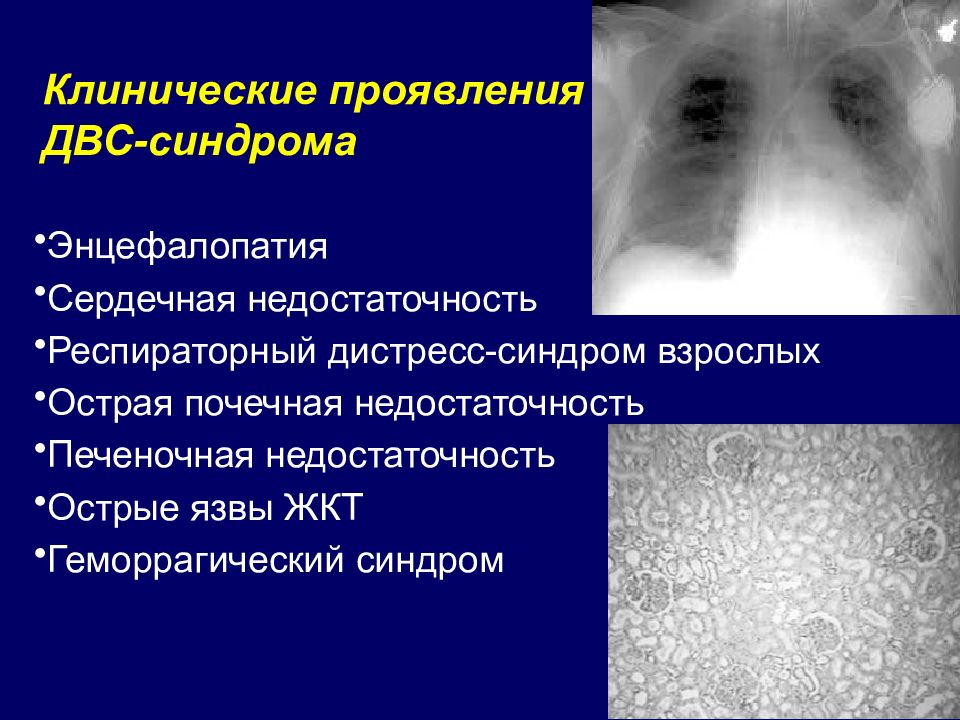 Презентация двс синдром у детей