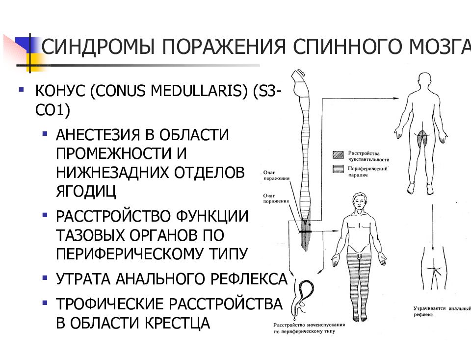 Поражение спинного мозга. Поражение конуса спинного мозга. Симптомы поражения конуса спинного мозга. Поражение поясничного утолщения спинного мозга симптомы. Синдром поражения конуса спинного мозга.