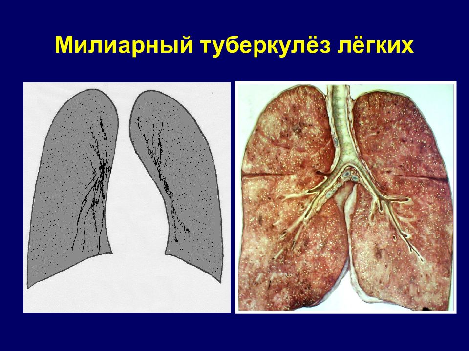 Туберкулез легких. Диссеминированный туберкулез макропрепарат. Милиарный диссеминированный туберкулез. Маллиарный туберкулезлегих. Диссеминированный туберкулез и милиарный туберкулез.