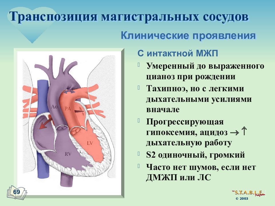 Транспозиция артерий