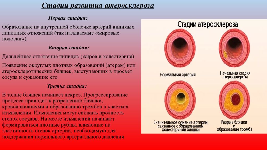 Стадии атеросклероза картинки