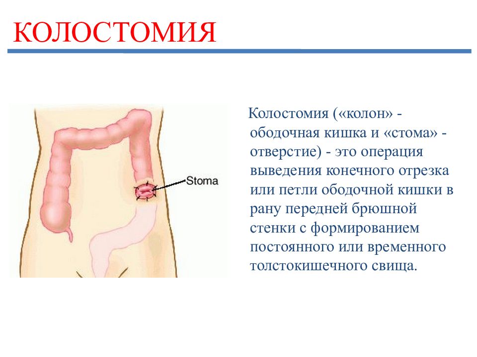 Презентация стомы и их виды