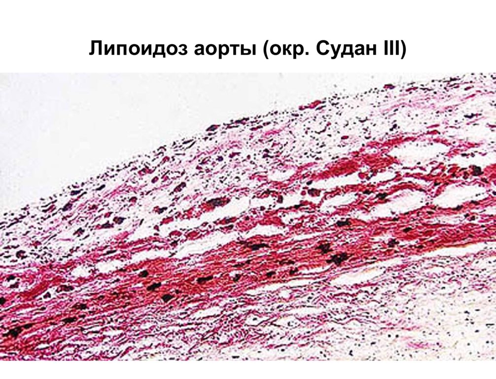 Микроскопическая картина атеросклероза аорты