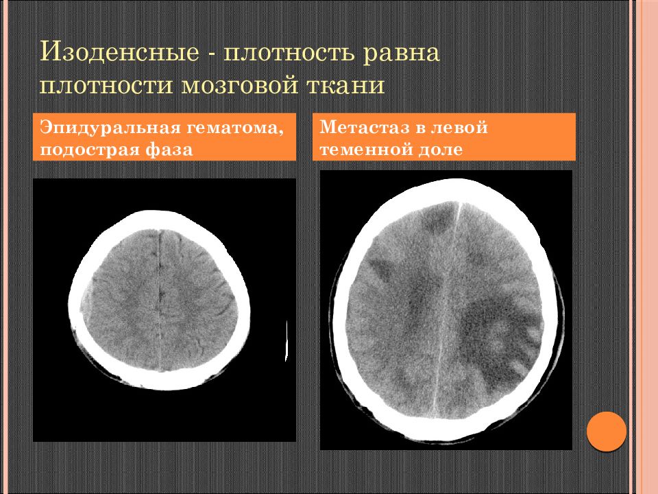 Диффузное снижение плотности. Образование головного мозга кт. Плотность головного мозга на кт. Плотность мозговой ткани.