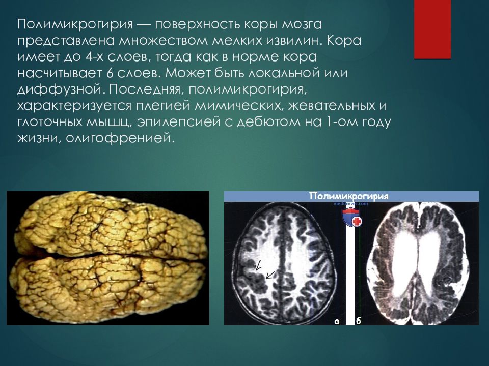 Пахигирия. Полимикрогирия мрт. Билатеральная полимикрогирия. Пахигирия головного мозга.