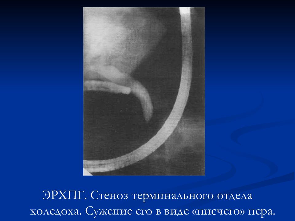 Синдром клешни презентация