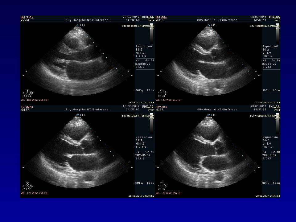 Эхокардиография сердца презентация