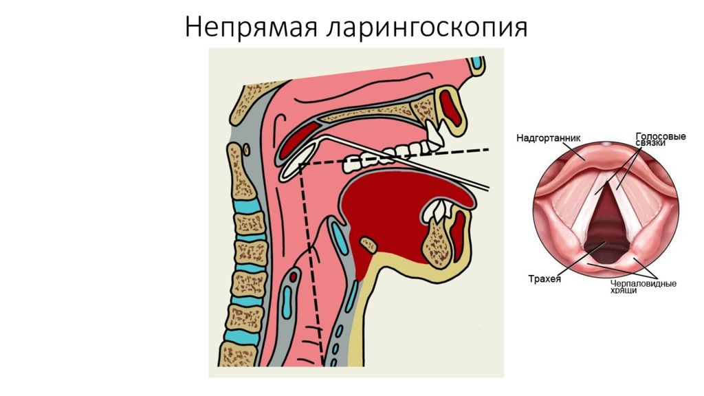 Ларингоскопия это