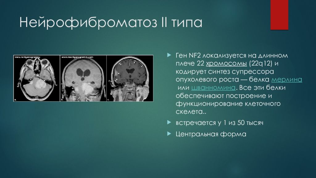Нейрофиброматоз — презентация