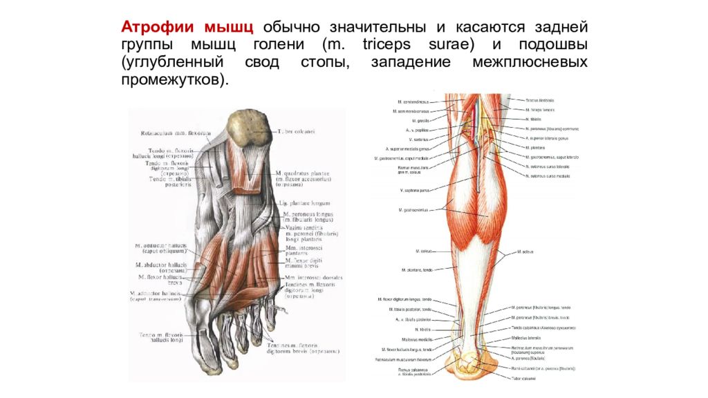 Мышечная атрофия. Задняя большеберцовая мышца иннервация. Мышцы голени Неттер. Мышцы голени задняя группа. Большеберцовый нерв анатомия.