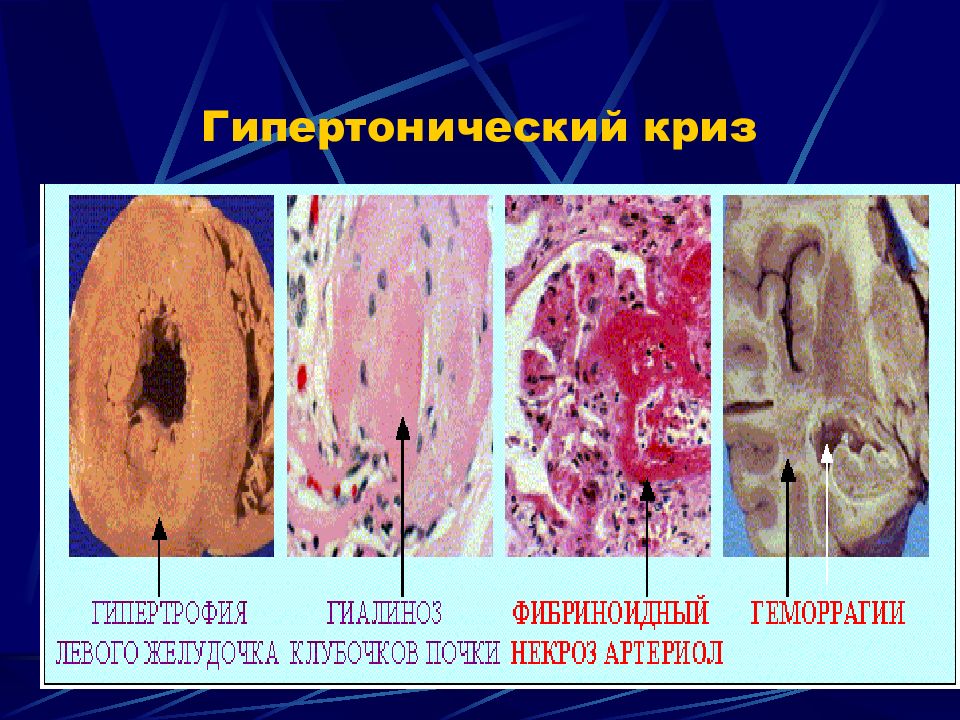 Что такое гипертонический криз. Гипертонические кризы. Гипертермический криз. Геспетранический Бриз. Квикс гипертонический.