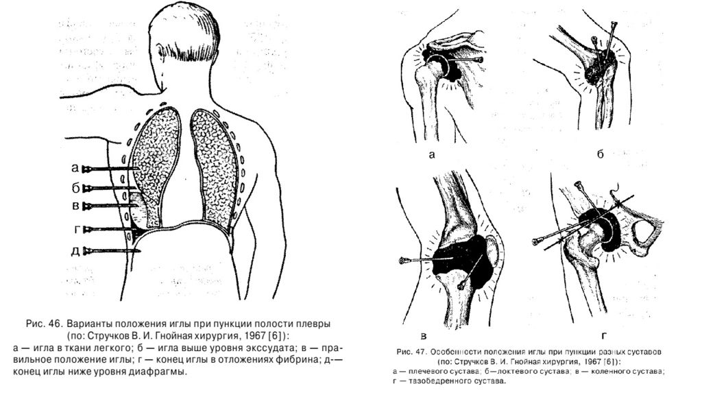 Пункция плечевого сустава. Пункция коленного сустава топографическая анатомия. Пункции плечевого сустава показания точки техника. Пункция плечевого сустава сзади. Техника пункции коленного сустава топографическая анатомия.