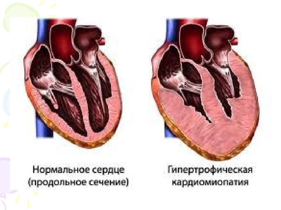 Стенки левого желудочка сердца. Дилатационная гипертрофия миокарда. Левый желудочек при ГКМП. Кардиопатия дилатационная кардиомиопатия. Синдром дилатационной кардиомиопатии.