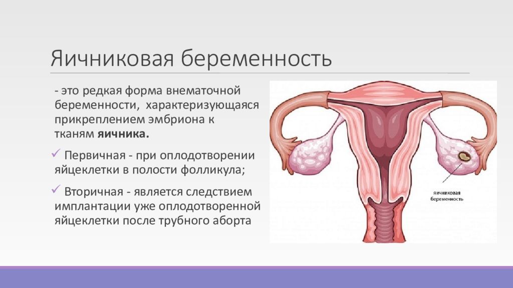 Эктопическая беременность презентация