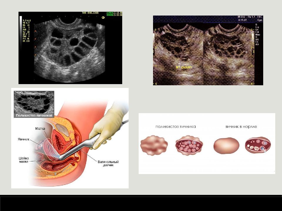 Фото поликистозного яичника