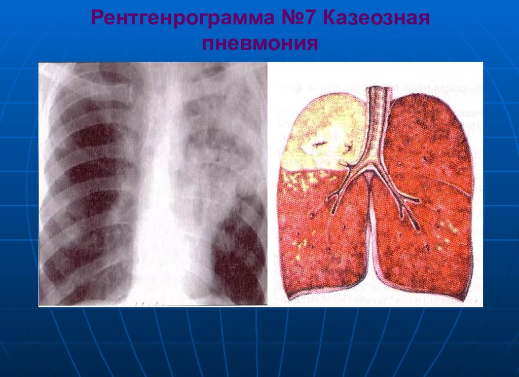 Фтизиатрия. Казеозная пневмония фтизиатрия. Казеозная и крупозная пневмония. Долевая казеозная пневмония.