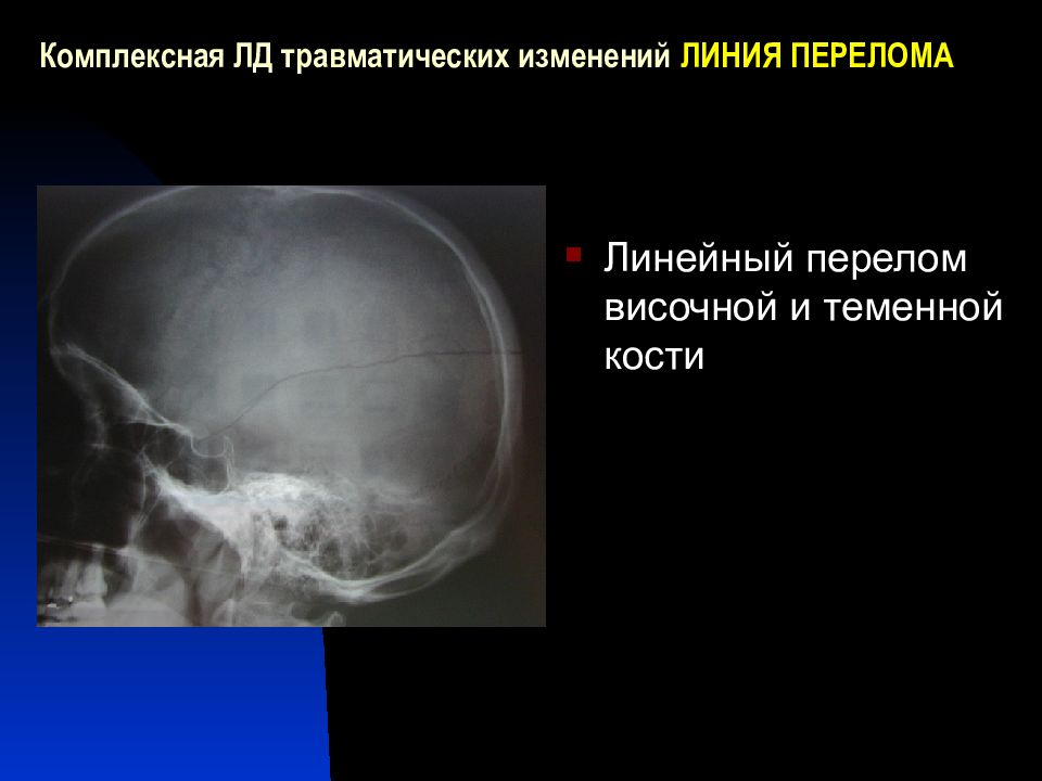 Линейная трещина. Линейный перелом височной кости.