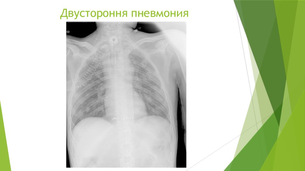 Двусторонняя пневмония. Билатеральная пневмония. Плевропневмония двусторонняя. Двустороннее воспаление.