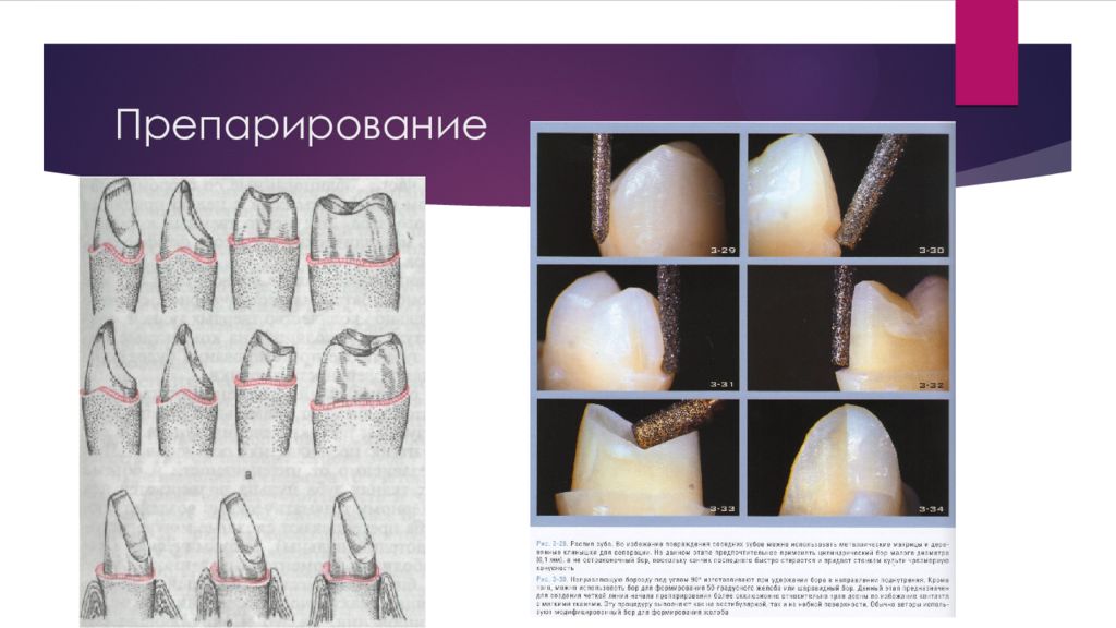 Фото препарирование под штампованную коронку