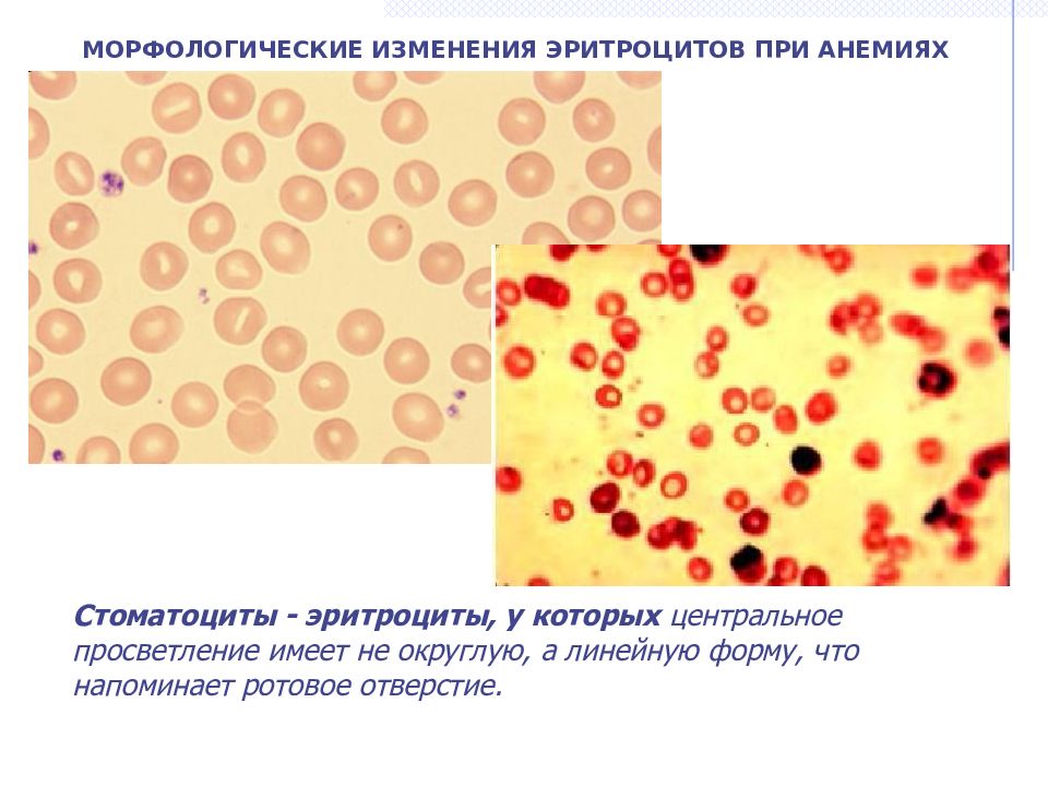 Измененные клетки. Изменение морфологии эритроцитов при анемиях. Морфологические изменения эритроцитов при железодефицитной анемии. Изменение формы эритроцитов при анемии. Изменения эритроцитов при микроскопии.