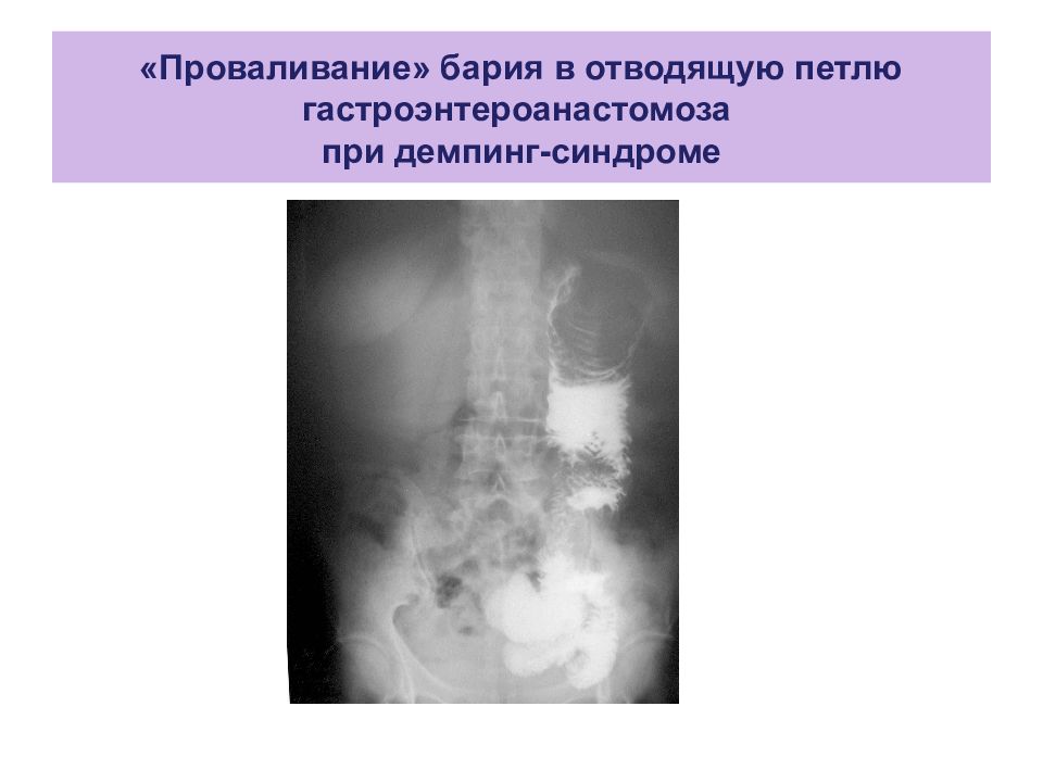 После бария. Демпинг синдром после резекции желудка на рентгене. Рентген при демпинг синдроме. Демпинг синдром рентген. Синдром приводящей петли рентген.