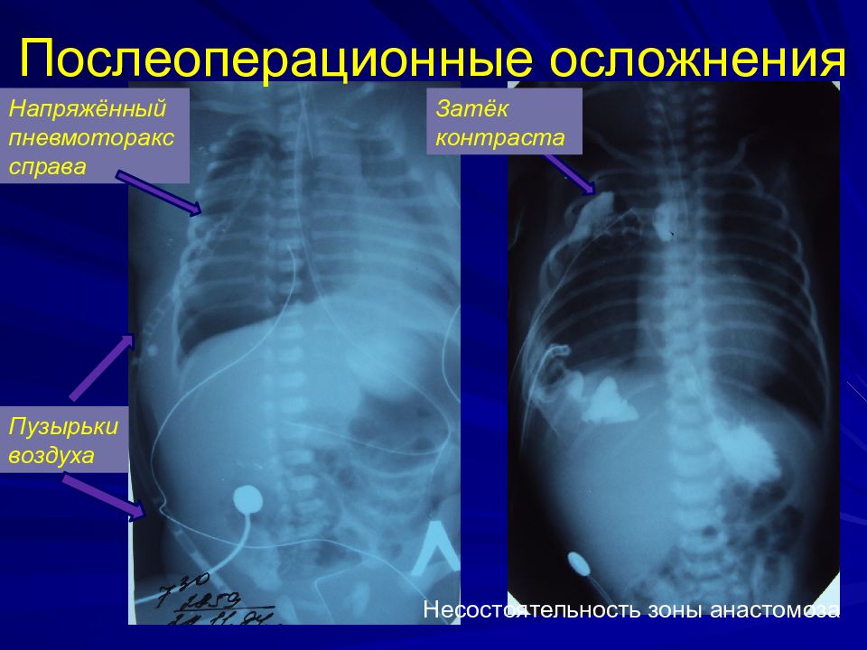 Атрезия пищевода. Атрезия пищевода презентация. Напряженный пневмоторакс осложнения. Послеоперационные осложнения затекания.