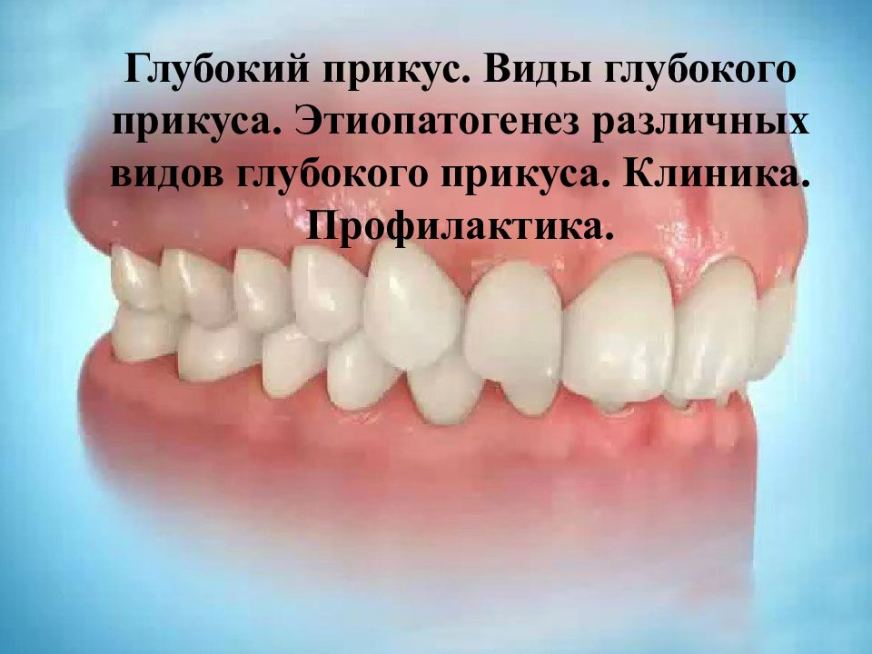 Виды глубокие. Глубокий прикус вид сбоку. Глубокий прикус презентация.