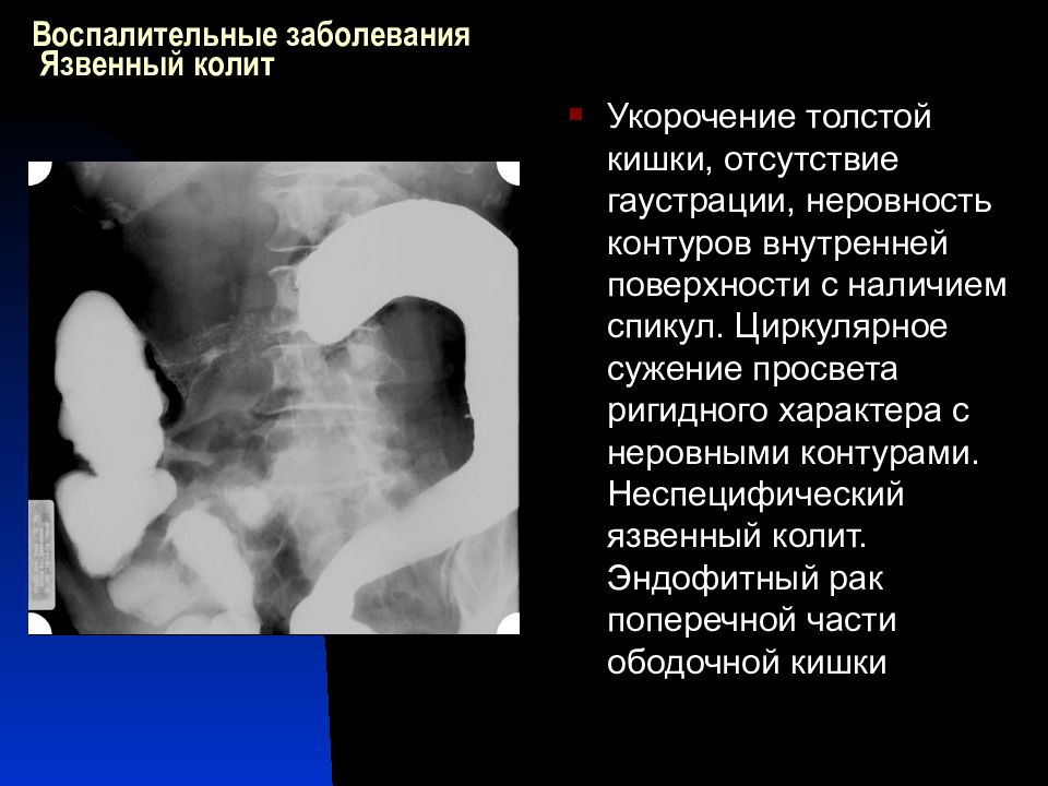 Метод диагностики заболевания толстой кишки изображенный на рисунке