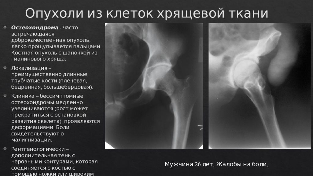 Костный отек. Остеохондрома плечевой кости рентген. Опухоли костей остеохондрома. Опухоль бедренной кости рентген. Остеохондрома шейки бедренной кости.