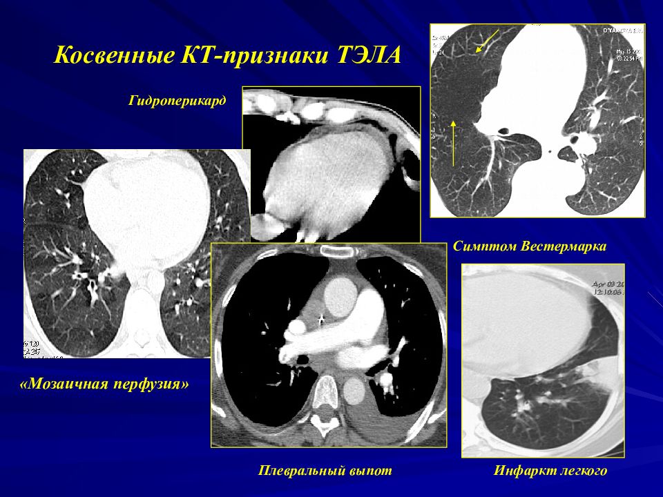 Кт признаки. Тромбоэмболия легочной артерии на кт. Хроническая тромбоэмболия легочной артерии на кт.
