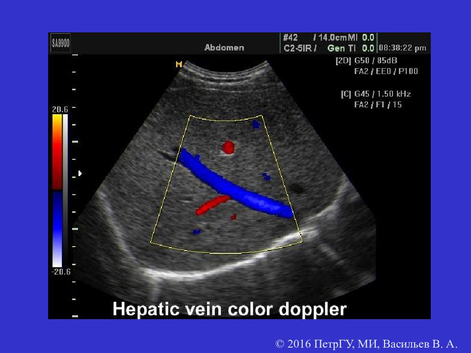 Допплер что это. Печеночная Вена допплер. УЗИ атлас печени. Допплер цвета сосудов.