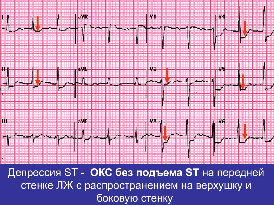 Презентация окс без подъема st