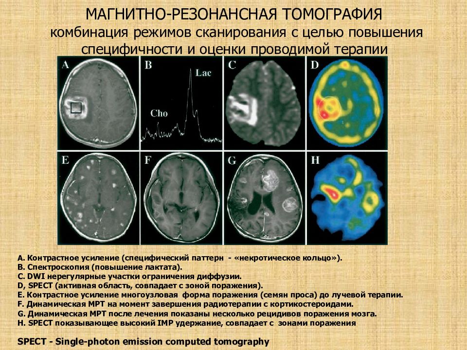 Опухоль мозга презентация