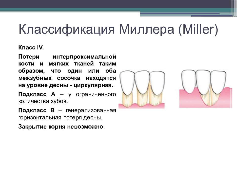 Классификация миллера. Классификация Миллера рецессии десны. Классификация по Миллеру. Классификация рецессий по Миллеру. Классы рецессии десны по Миллеру.