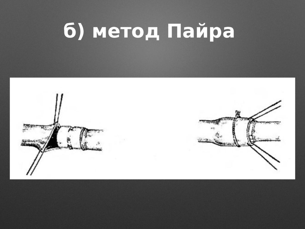 Бесшовное соединение сосудов метод а г коневского. Шов Соловьева сосудистый. Инвагинационный сосудистый шов.