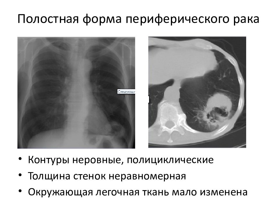 Лучевая диагностика рака легкого презентация