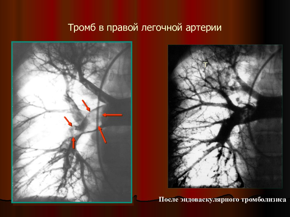 Ветви в легких. Ангиопульмонография Тэла. Эмболии легочной артерии кт. Тэла тромболизис.