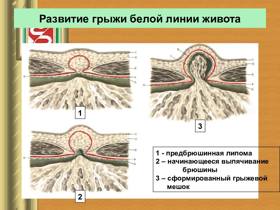 Ущемленная грыжа передней брюшной стенки. Грыжа передней брюшной стенки. Грыжа белой линии живота. Грыжа впереди брюшной стенки. Грыжа передней брюшной стен.