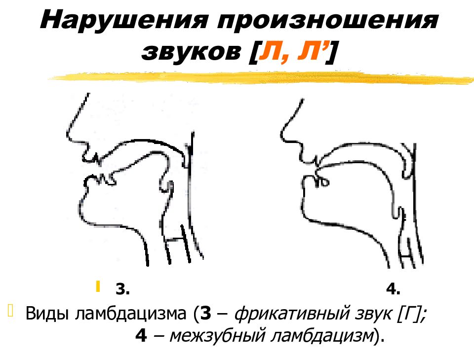 Латеральный профиль. Недостатки произношения звуков л и л'.. Виды ламбдацизма в логопедии. Межзубное произношение звука л. Нарушение произношения звуков.