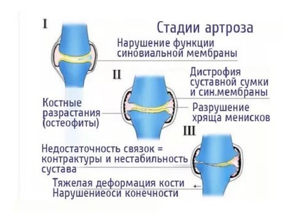 Артроз коленного сустава мениск. Деформирующий артроз коленного сустава схема. Схема развития деформирующего остеоартроза. Стадии деформирующего артроза.